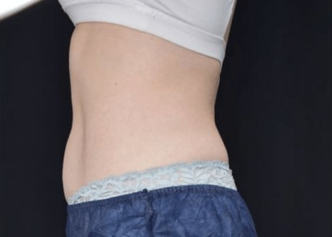 After BodySculpt treatment