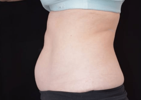 Before BodySculpt treatment