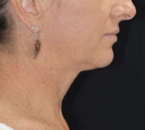 After BodySculpt treatment