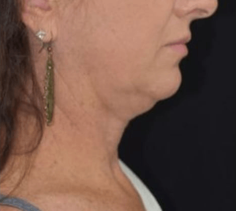 Before BodySculpt treatment