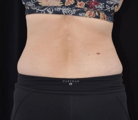 After BodySculpt treatment