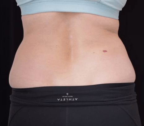 Before BodySculpt treatment