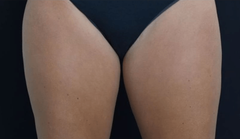After BodySculpt treatment