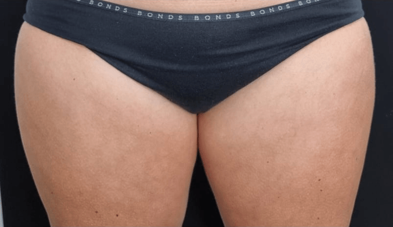 Before BodySculpt treatment