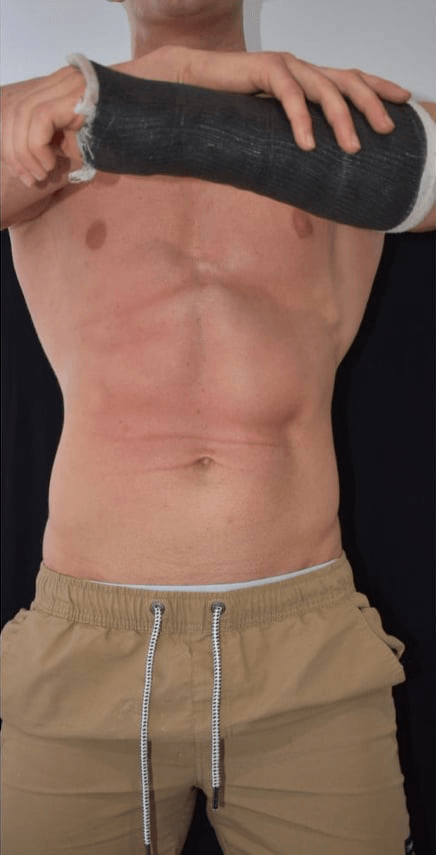 Before BodySculpt treatment