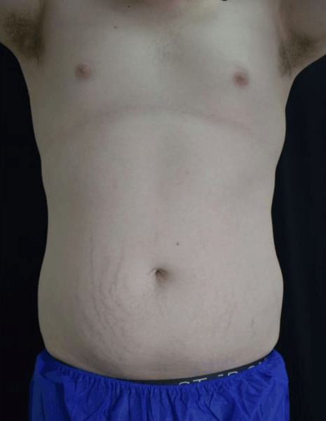 After BodySculpt treatment