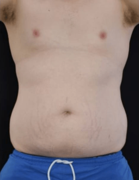 Before BodySculpt treatment