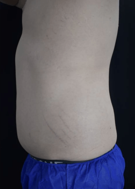 After BodySculpt treatment