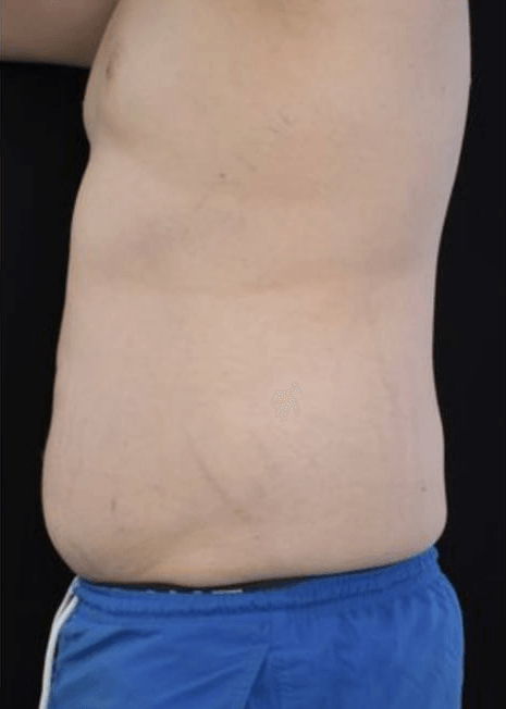 Before BodySculpt treatment