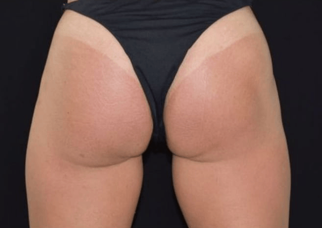 After BodySculpt treatment