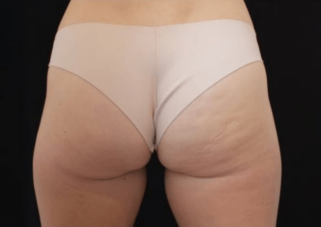 Before BodySculpt treatment