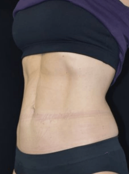 After BodySculpt treatment
