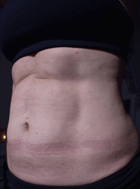 Before BodySculpt treatment