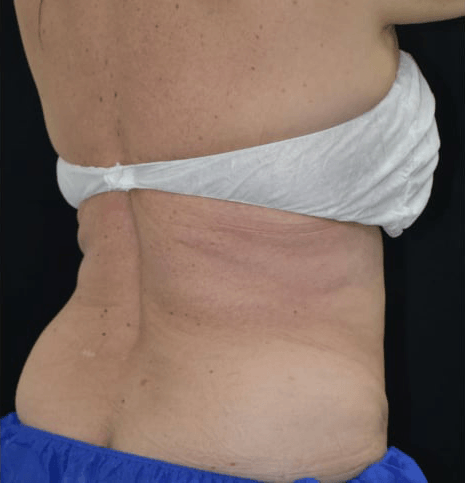 After BodySculpt treatment
