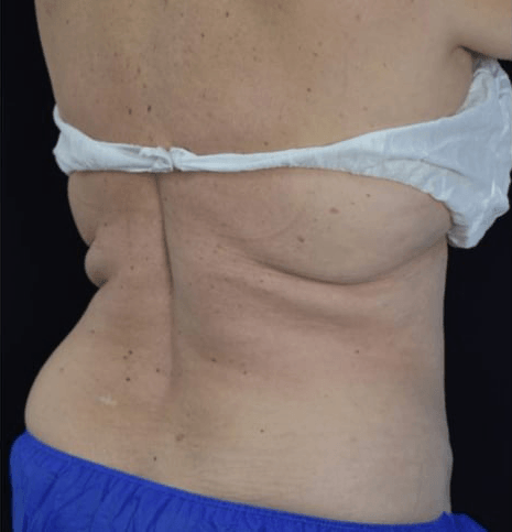Before BodySculpt treatment