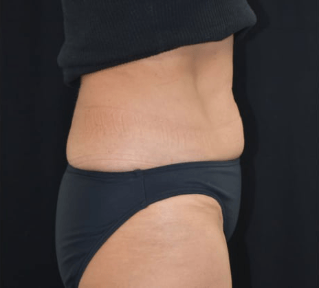 After BodySculpt treatment