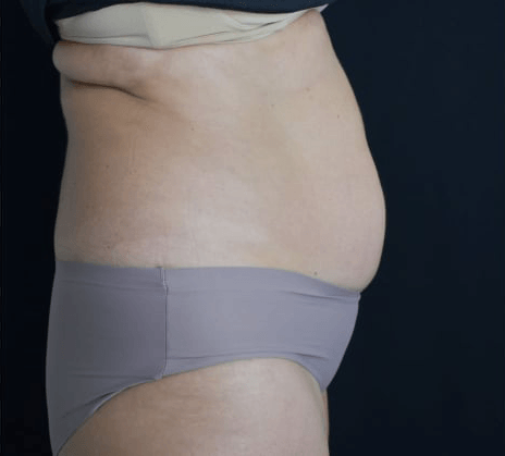 Before BodySculpt treatment