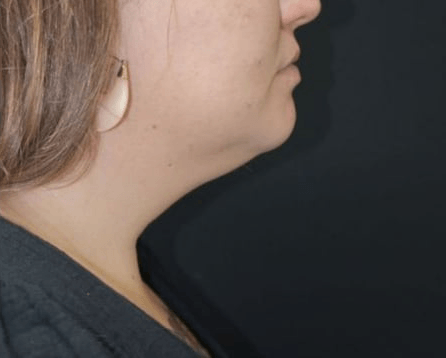 After BodySculpt treatment