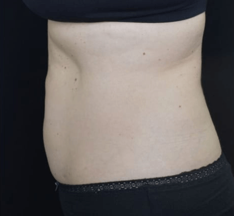 After BodySculpt treatment