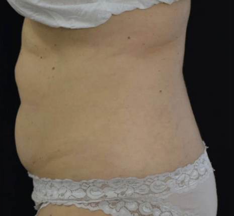 Before BodySculpt treatment