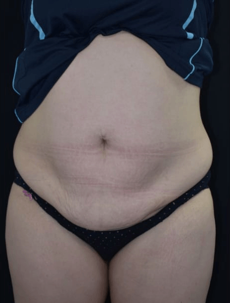 After BodySculpt treatment