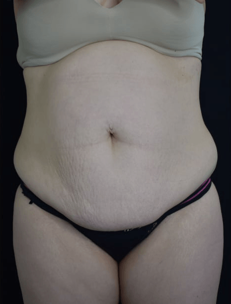 Before BodySculpt treatment