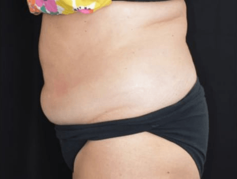 After BodySculpt treatment