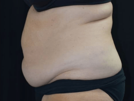 Before BodySculpt treatment