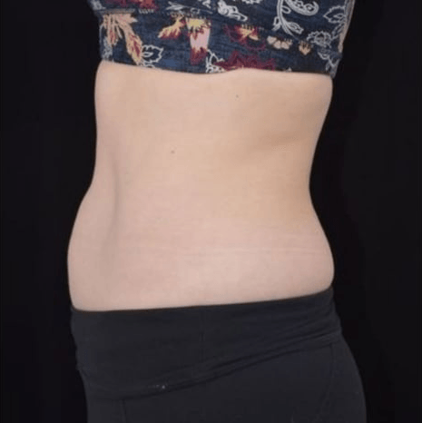 After BodySculpt treatment