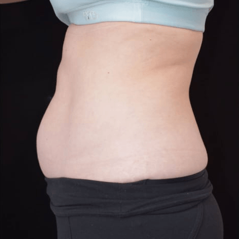 Before BodySculpt treatment