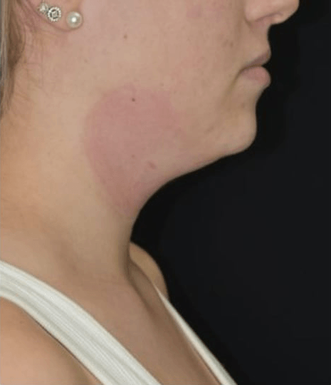 Before BodySculpt treatment