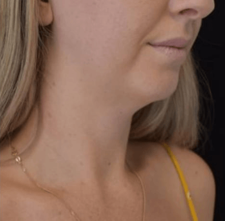 Before BodySculpt treatment