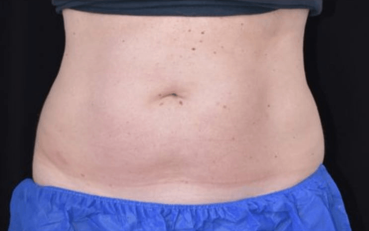 After BodySculpt treatment