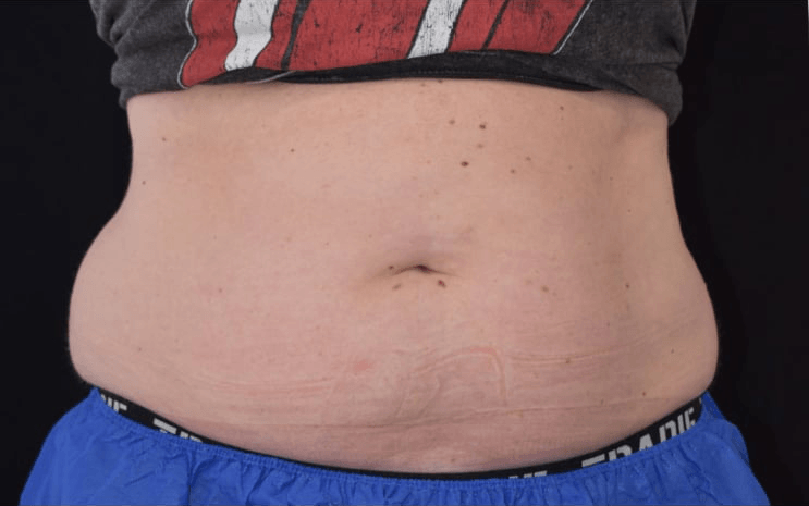 Before BodySculpt treatment