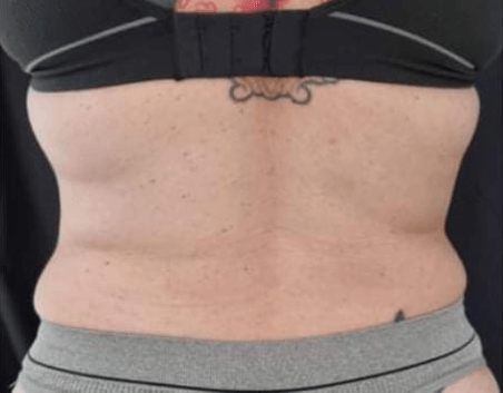 After BodySculpt