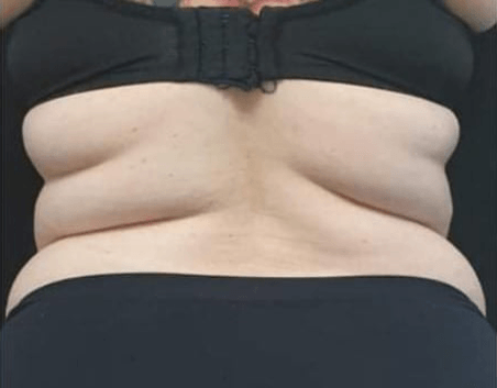 Before BodySculpt