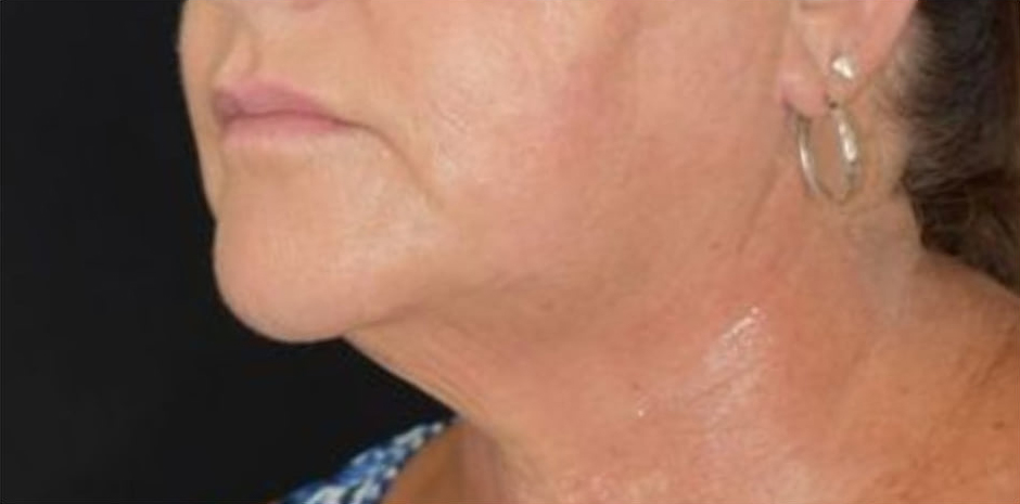 After BodySculpt treatment