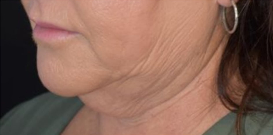 Before BodySculpt treatment