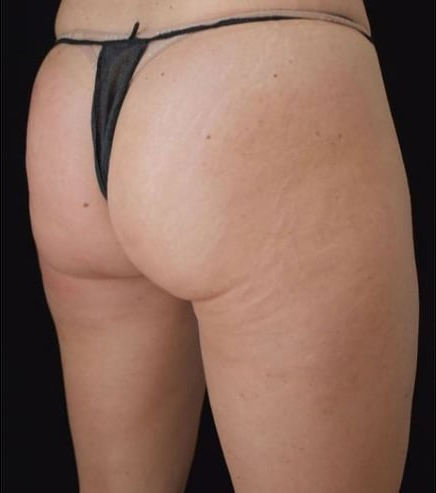 After BodySculpt treatment