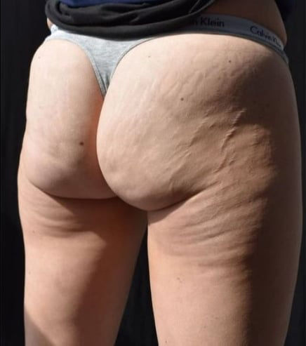 Before BodySculpt treatment
