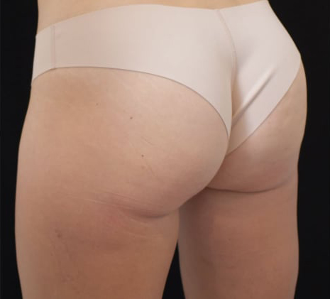 Before BodySculpt treatment