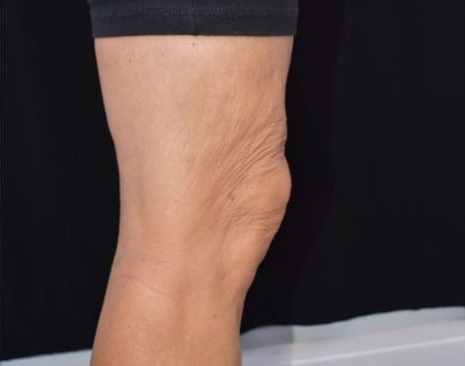 Before BodySculpt treatment