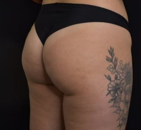 After BodySculpt treatment