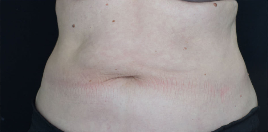 After BodySculpt treatment