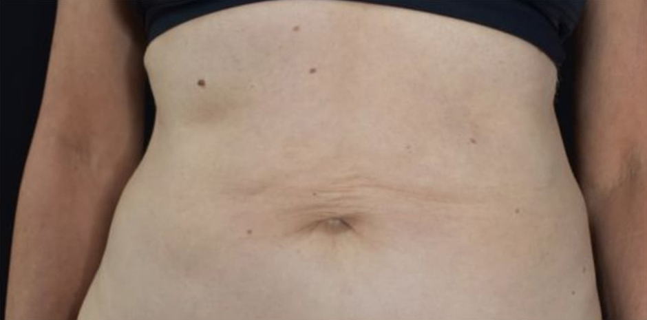 Before BodySculpt treatment