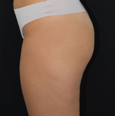 Before BodySculpt treatment