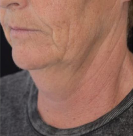 Before BodySculpt treatment
