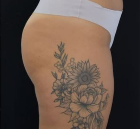 Before BodySculpt treatment