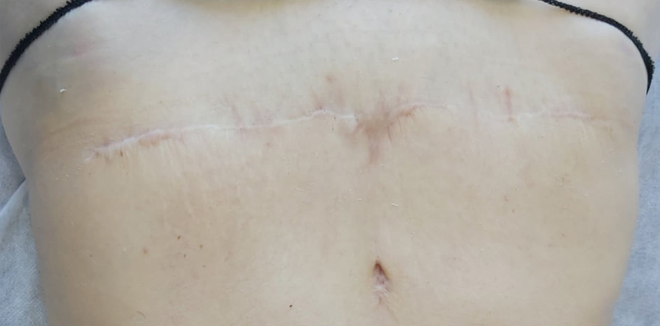 After BodySculpt treatment