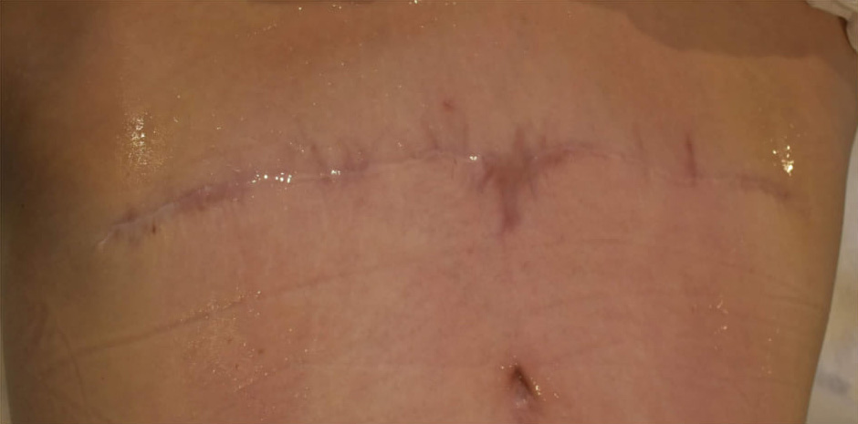 Before BodySculpt treatment